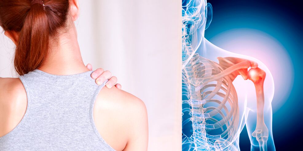 Развитие артроза плеча постепенно приводит к постоянным болям